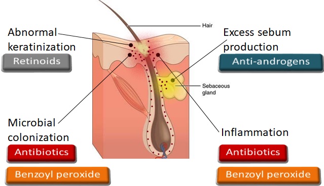 Figure 2. The four main pathways in the pathogenesis of acne and their medical interventions. Androgen-driven excess sebum production can be counteracted by anti-androgens. Vitamin A derivatives, retinoids normalize skin shedding and thus inhibit obstruction of pores. Antibiotics and antiseptics, like benzoyl peroxide kill bacteria and reduce inflammation.  