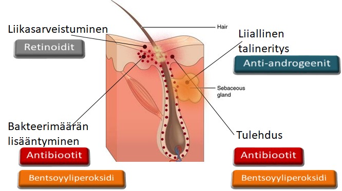 Kuva 2. Aknen syntymekanismi on jaettavissa neljään eri reittiin, johon kuhunkin voidaan vaikuttaa lääkkeellisesti. Liiallinen talineritys on androgeenien ohjaamaa ja sitä voidaan estää anti-androgeeneillä. Liikasarveistumista ja talirauhastiehyeen tukkeutumista hillitään A-vitamiinipohjaisilla valmisteilla, retinoideilla. Antibiootit ja antiseptiset yhdisteet kuten bentsoyyliperoksidi tappavat bakteereja ja vähentävät tulehdusta. Sebaceous gland = talirauhanen 